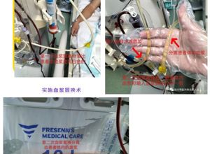 【新技术】我院重症医学科成功开展首例高脂血症性急性胰腺炎血浆置换术