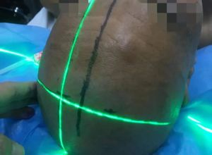 吴川首例！我院神经外科一区开启脑出血精准治疗新篇章
