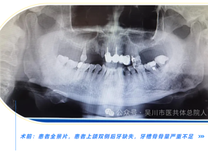 【新技术】高龄老人也可以种牙啦！我院口腔科成功采用上颌窦外提升术为80岁老人行种植牙植骨术