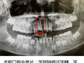 我院口腔科开展首例活髓切断术