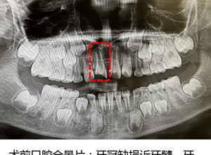 我院口腔科开展首例活髓切断术