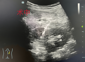 我院超声科成功施行首例超声引导下肾肿瘤穿刺活检术
