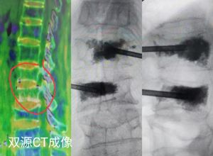 98岁高龄老人骨折到我院施行微创手术后舞动双手、喜笑颜开