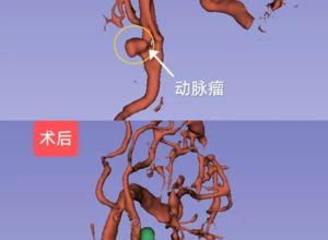 再创生命奇迹！我院神经外科成功开展高难度脑动脉瘤夹闭术
