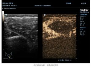 我院超声科成功开展甲状腺囊肿并囊内出血微波消融术