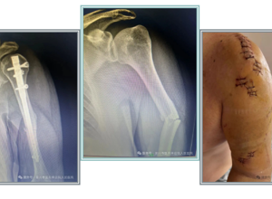 骨外科二区：熟练运用髓内钉技术治疗各类型骨折