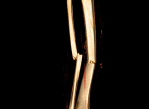 我院骨外科一区成功为13岁少年实施骨折微创手术