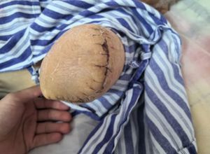 我院骨外科三区成功救治92岁高龄创伤危重患者