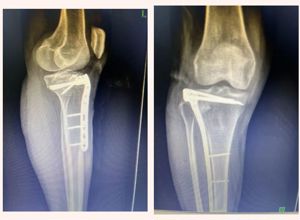 【新技术】我院骨外科二区利用微创技术破解复杂胫骨平台骨折治疗难题